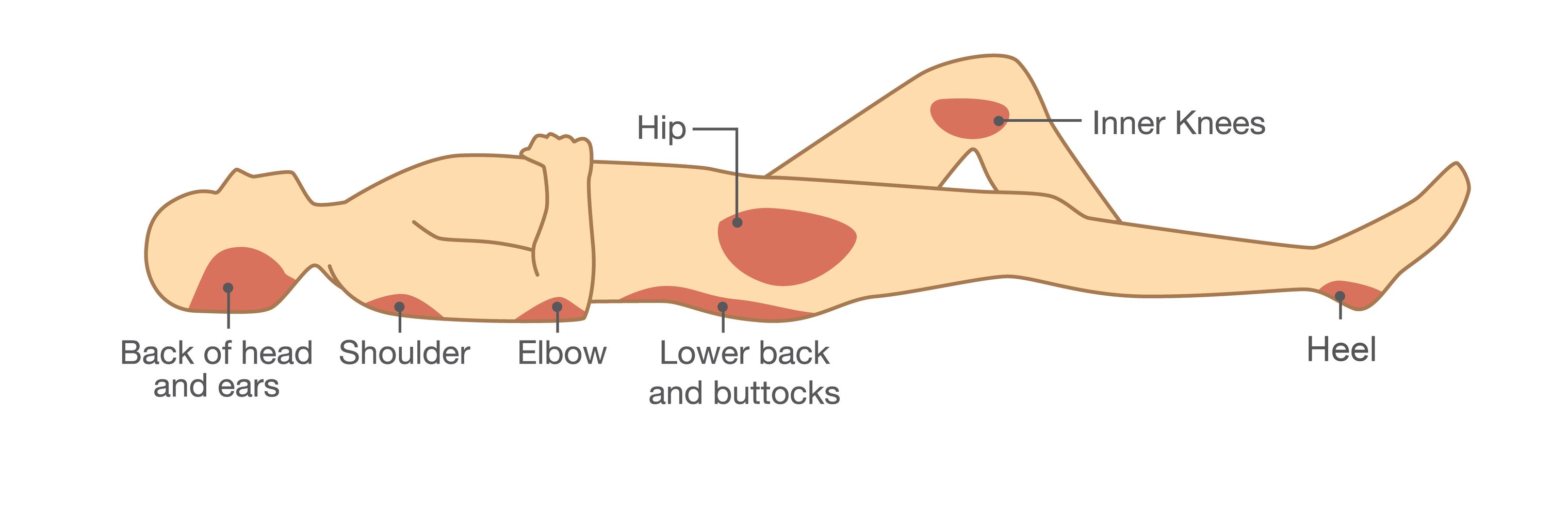 Airisana Guide to Pressure Injury Prevention